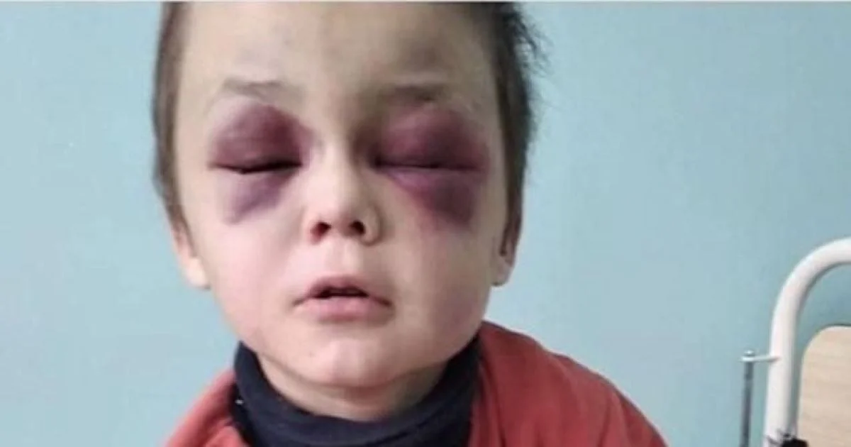 4-річний хлопчик з Сумщини з синцями обличчя після побиття пяним сусідом